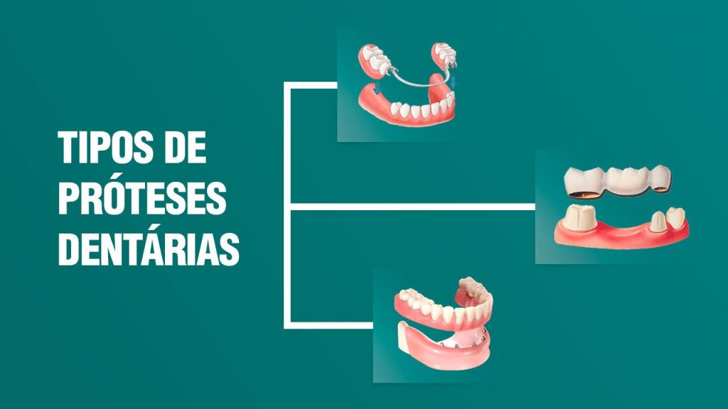 Prótese Dentária em Juazeiro do Norte Dentista Crato Barbalha